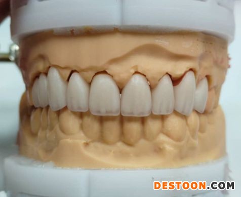 加拿大义齿加工厂-义齿厂家-种植牙-全瓷牙-超薄贴面定制加工